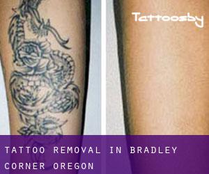 Tattoo Removal in Bradley Corner (Oregon)