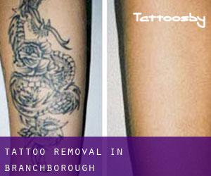 Tattoo Removal in Branchborough