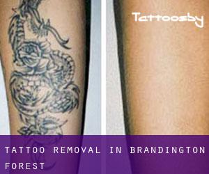 Tattoo Removal in Brandington Forest