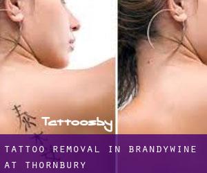 Tattoo Removal in Brandywine at Thornbury