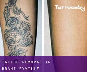 Tattoo Removal in Brantleyville