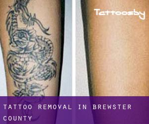 Tattoo Removal in Brewster County