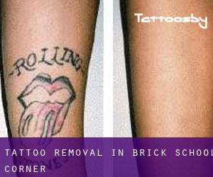 Tattoo Removal in Brick School Corner