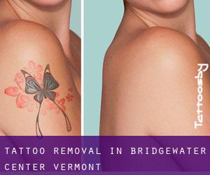 Tattoo Removal in Bridgewater Center (Vermont)