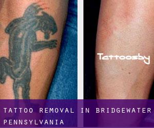 Tattoo Removal in Bridgewater (Pennsylvania)