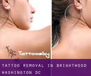 Tattoo Removal in Brightwood (Washington, D.C.)
