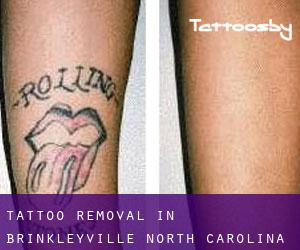 Tattoo Removal in Brinkleyville (North Carolina)
