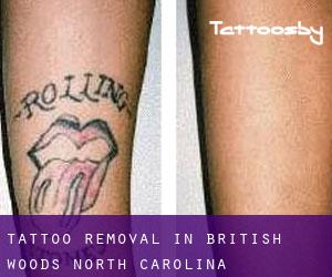 Tattoo Removal in British Woods (North Carolina)