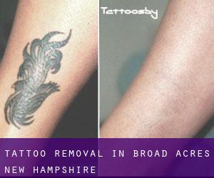 Tattoo Removal in Broad Acres (New Hampshire)