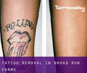 Tattoo Removal in Broad Run Farms