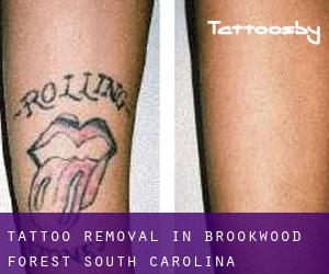 Tattoo Removal in Brookwood Forest (South Carolina)