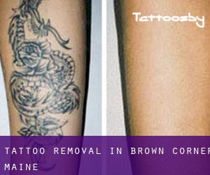 Tattoo Removal in Brown Corner (Maine)