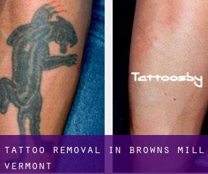 Tattoo Removal in Browns Mill (Vermont)