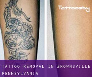 Tattoo Removal in Brownsville (Pennsylvania)