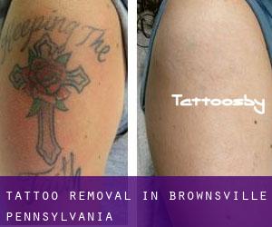 Tattoo Removal in Brownsville (Pennsylvania)