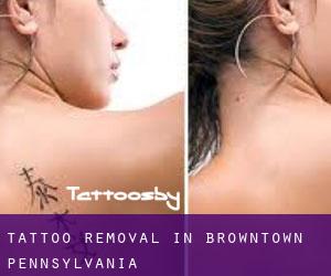 Tattoo Removal in Browntown (Pennsylvania)