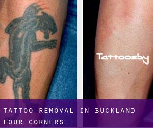 Tattoo Removal in Buckland Four Corners