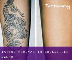 Tattoo Removal in Bucksville Manor