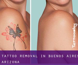 Tattoo Removal in Buenos Aires (Arizona)