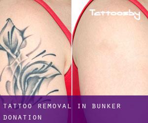 Tattoo Removal in Bunker Donation