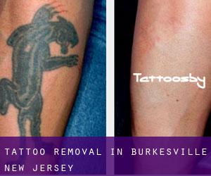 Tattoo Removal in Burkesville (New Jersey)