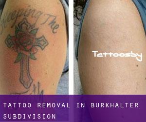 Tattoo Removal in Burkhalter Subdivision