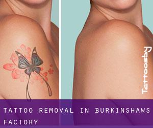 Tattoo Removal in Burkinshaws Factory