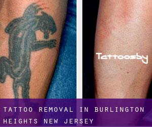 Tattoo Removal in Burlington Heights (New Jersey)
