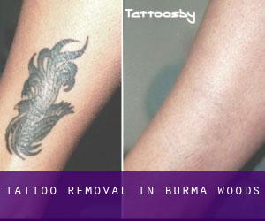 Tattoo Removal in Burma Woods