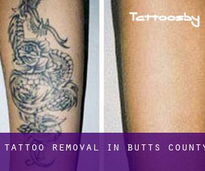 Tattoo Removal in Butts County