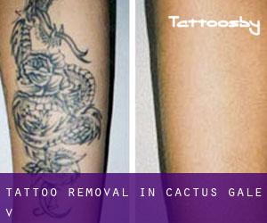 Tattoo Removal in Cactus Gale V