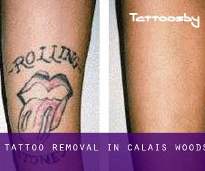 Tattoo Removal in Calais Woods