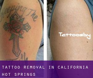 Tattoo Removal in California Hot Springs