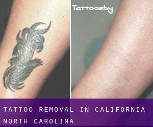 Tattoo Removal in California (North Carolina)
