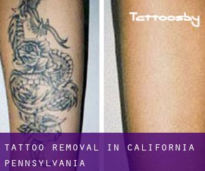 Tattoo Removal in California (Pennsylvania)