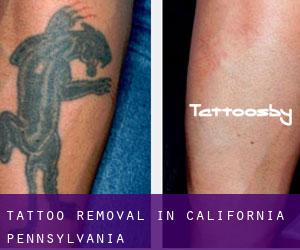 Tattoo Removal in California (Pennsylvania)