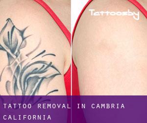 Tattoo Removal in Cambria (California)