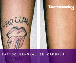 Tattoo Removal in Cambria Hills