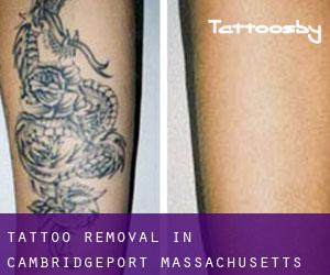 Tattoo Removal in Cambridgeport (Massachusetts)