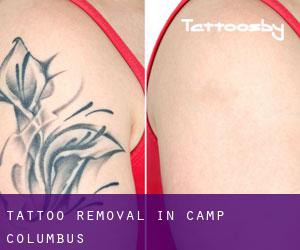 Tattoo Removal in Camp Columbus