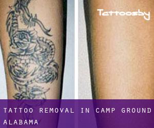 Tattoo Removal in Camp Ground (Alabama)