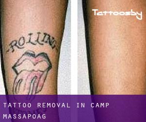 Tattoo Removal in Camp Massapoag