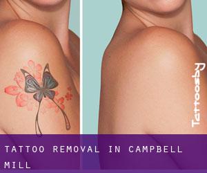 Tattoo Removal in Campbell Mill