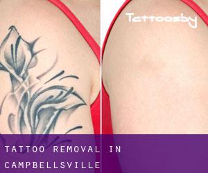 Tattoo Removal in Campbellsville