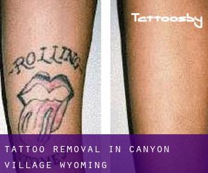 Tattoo Removal in Canyon Village (Wyoming)