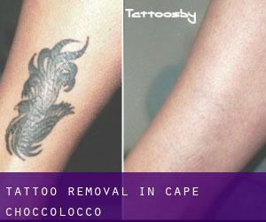 Tattoo Removal in Cape Choccolocco