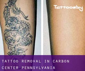Tattoo Removal in Carbon Center (Pennsylvania)