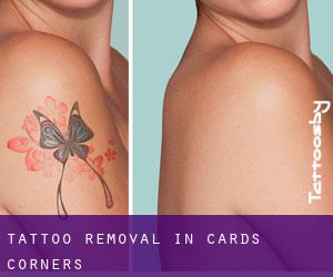 Tattoo Removal in Cards Corners