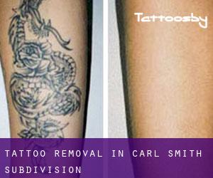 Tattoo Removal in Carl Smith Subdivision