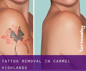 Tattoo Removal in Carmel Highlands